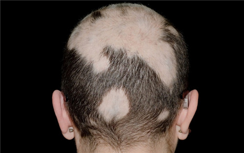 斑秃可以用哪些药物和手术治疗