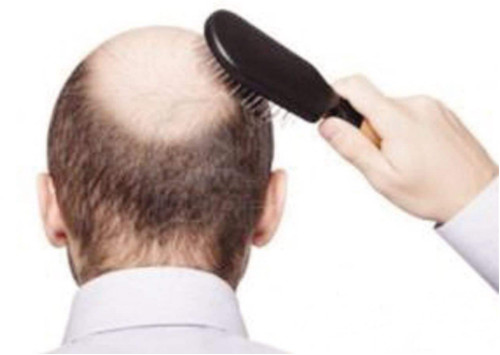 如何解决男性脱发的问题？