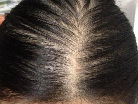 女性秃顶都有些什么症状呢