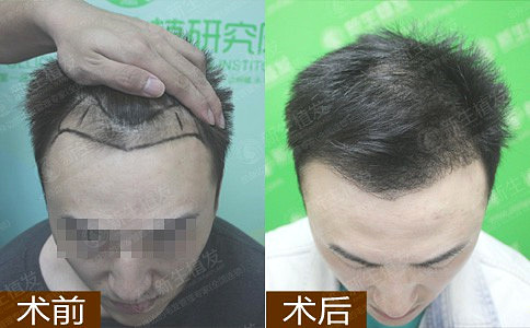 在上海掉头发严重应该怎么办？