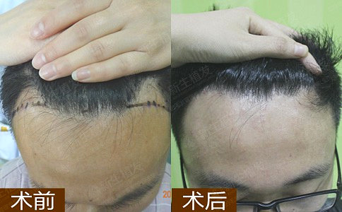 杭州如何治疗脱发才是较好的