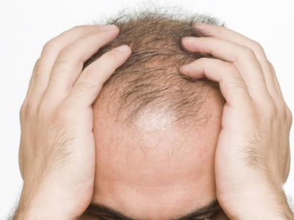 头皮疼脱发的原因是什么呢
