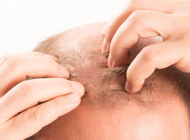 神经性皮炎会导致脱发吗