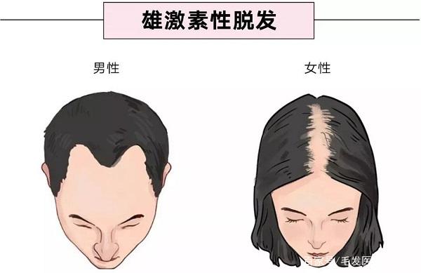 说到脱发，很多人都被雄激素脱发所困，雄激素会导致脱发？