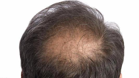 古人防脱发一年不洗头也太拼了，脱发怎么办？