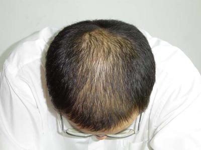 治疗脱发的偏方都有什么？