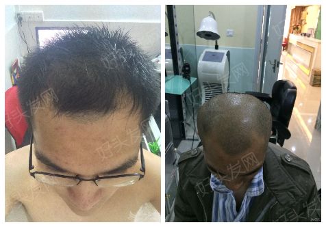 广州植发前额三级脂溢性脱发