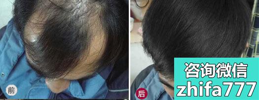 深圳仁爱医院新生植发为脂溢性脱发患者植发