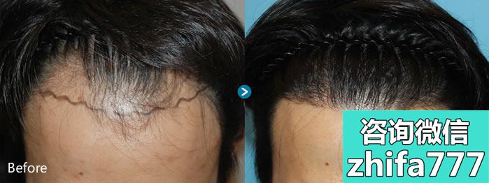 韩国毛杰琳毛发移植手术前后照片