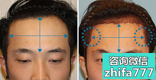韩国毛杰琳毛发移植中心男性植发术后效果对比