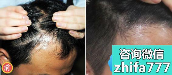 广州雍禾植发案例 脱发男性选择LATTICE加密头发