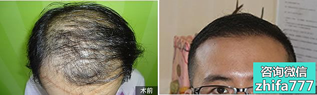 重庆重生植发案例 秃顶教师重返青春