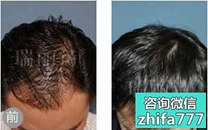 西安植发案例 PHT植发手术治疗遗传性脱发
