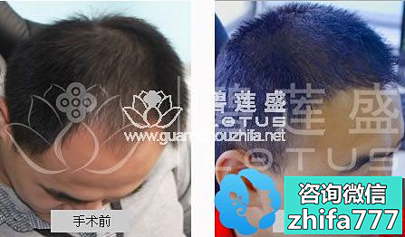 广州碧莲盛植发案例 头发稀疏加密手术