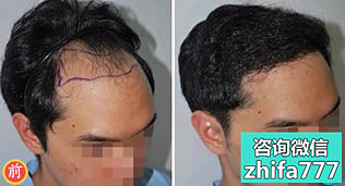 徐州有美植发案例 FUE隐痕植发治疗遗传性脱发
