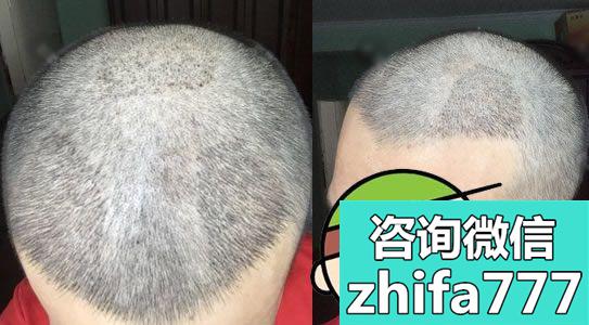 上海华美植发经历分享给大家，价格2万多，就前3个月比较难熬