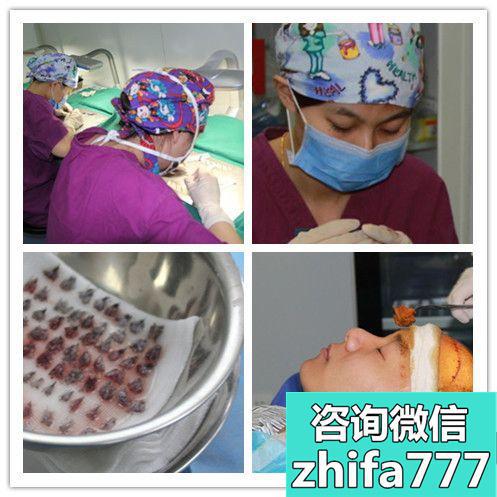 北京博士园植发案例：mut植发技术3200毛囊单位六个月恢复效果