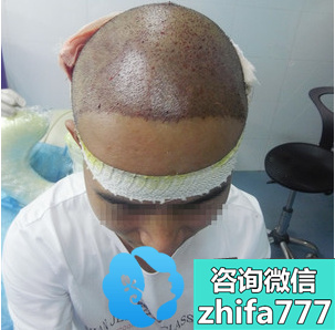 4级脱发大叔在深圳鹏程医院植发科头顶加密3000单位扭转形象