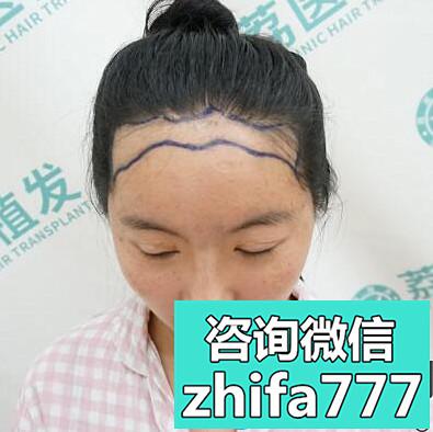 相信广州荔医的实力找尚俊做了发际线种植，来看看效果图