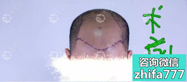 厦门美莱头顶稀疏加密植发术后10天、一个月效果图