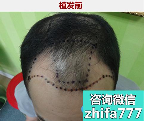 男士植发案例！北京博士园王朝刚种植发际线3个月效果呈现