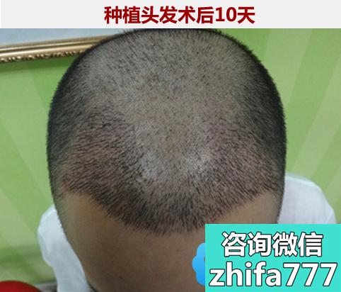男士植发案例！北京博士园王朝刚种植发际线3个月效果呈现