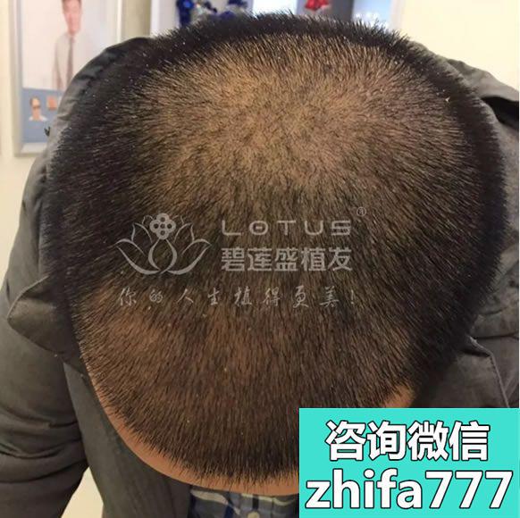 植发多久才有效果？上海碧莲盛种植发际线术后8个月案例反馈