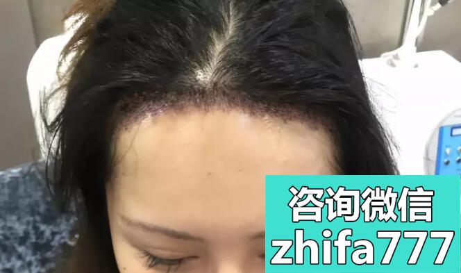 发际线高怎么改善，公布我在深圳倍生植发际线8天头发变化照