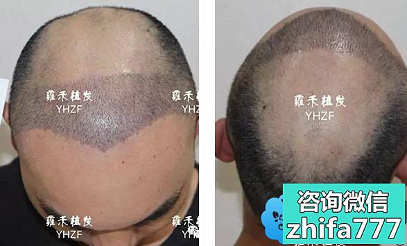 温州雍禾种植了不到3000单位的头发 能让我告别七级脱发吗