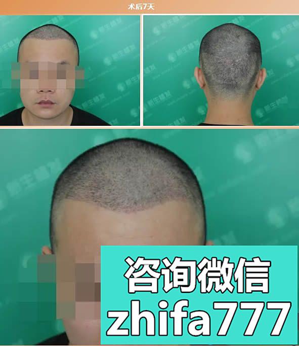 我被诊断为四级脱发，在上海新生花39860元种植了前额发际线