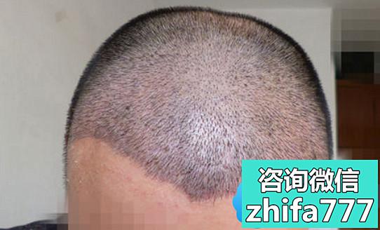 因为雄脱我在郑州华山医院做了植发并分享2年来头发的情况