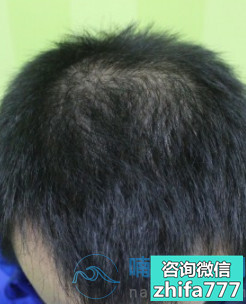 成都首瑞发际线种植，头发长得好快！