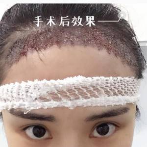 北京植发小仙女种植发际线1500毛囊单位案例分享