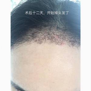 北京植发小仙女种植发际线1500毛囊单位案例分享