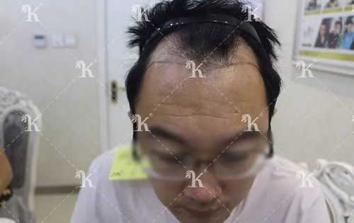 杨先生8年脱发前额头顶植发11月变身儒雅俊男