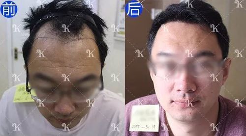 杨先生8年脱发前额头顶植发11月变身儒雅俊男