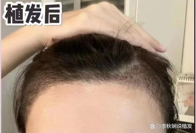 接受不了高发际线，跑北京做了植发亲身经历