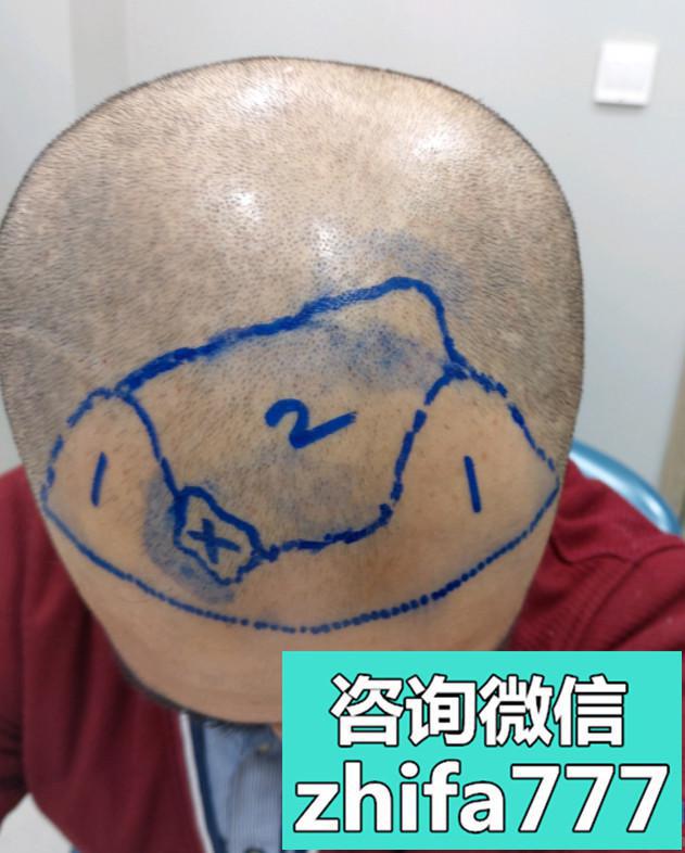 南京植发发际线种植，术后效果显脸小了