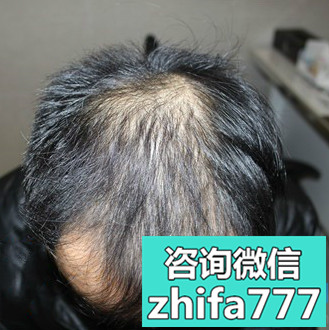 杭州新生秃顶植发效果怎么样呀