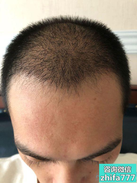 西安熙朵秃顶植发术后分享