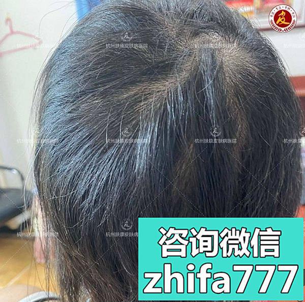 我花1万多在杭州做的斑秃植发有较好效果，且不担心还会再掉