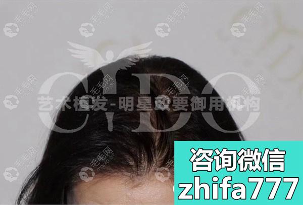 女性头顶稀疏植发成功案例，北京熙朵这头发移植效果可靠！