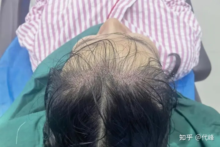 女性发际线植发长短发结合植发案例