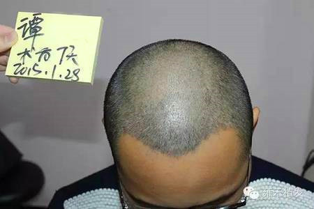 男士头顶稀疏加密植发是怎么变密的？