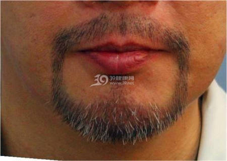 男士胡须种植加上眉毛种植效果案例