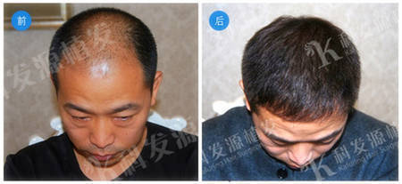 男士5级脱发杭州头发种植毛囊移植4680单位