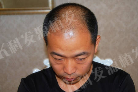 男士5级脱发杭州头发种植毛囊移植4680单位