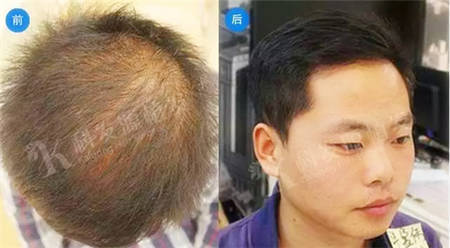 男士头发稀疏加密植发手术之后对比