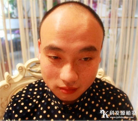 小伙脱发严重上海头发种植案例效果
