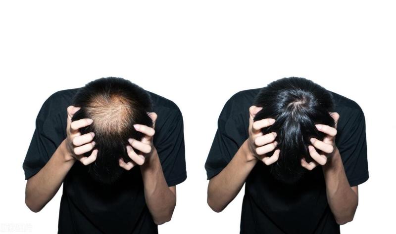 关于脱发你是真的了解吗？6个脱发原因，从根本上解决脱发问题！
